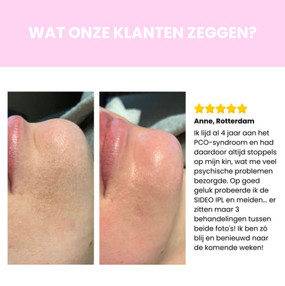 Sideo IPL Haarverwijderaar – Professionele laserontharing voor thuisgebruik